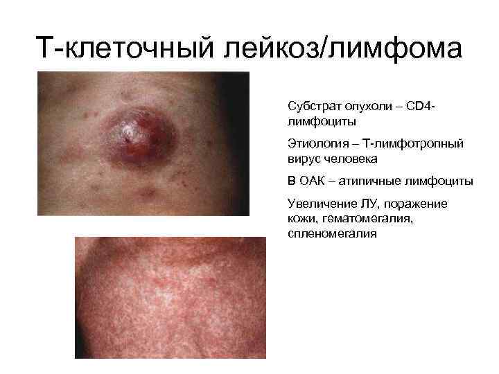Т-клеточный лейкоз/лимфома Субстрат опухоли – CD 4 лимфоциты Этиология – Т-лимфотропный вирус человека В