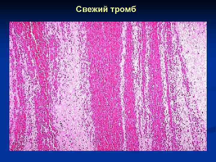 Свежий тромб 