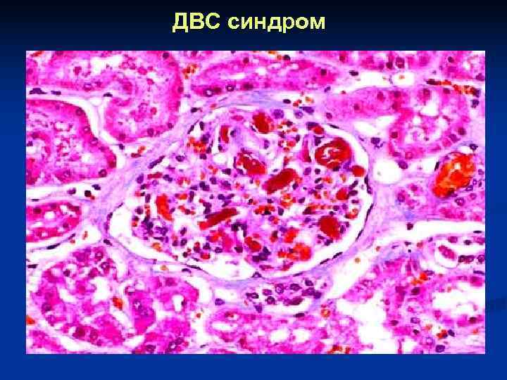 ДВС синдром 