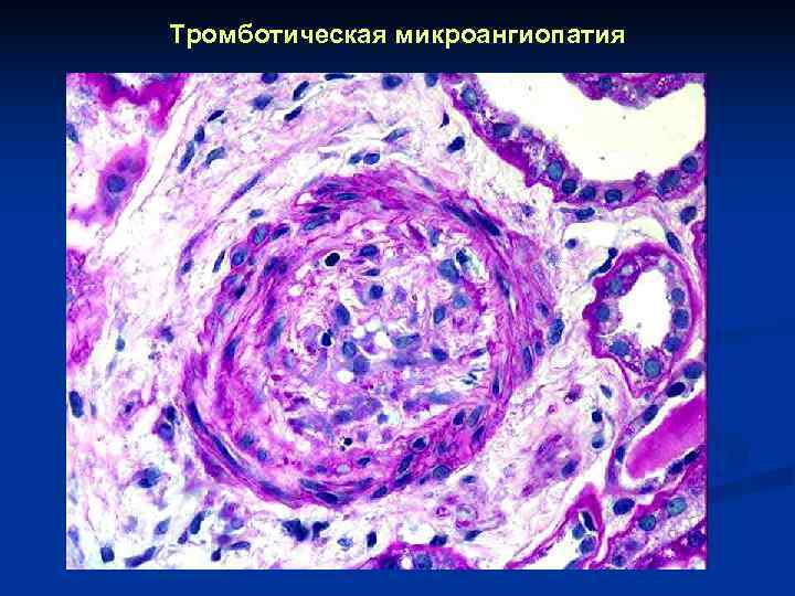 Тромботическая микроангиопатия 