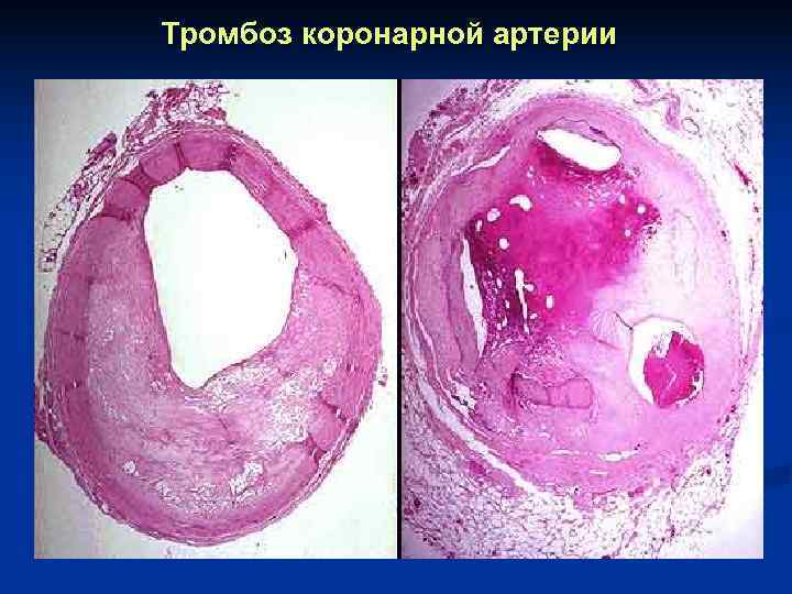 Тромбоз коронарной артерии 