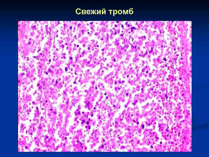Свежий тромб 