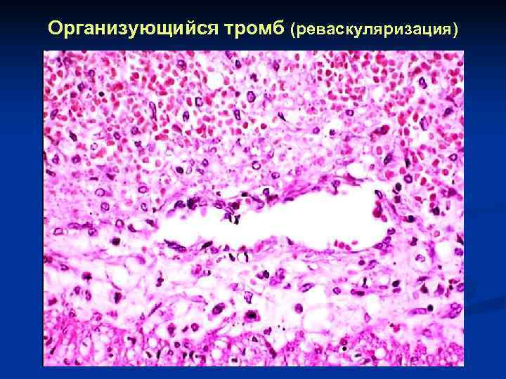 Организующийся тромб (реваскуляризация) 