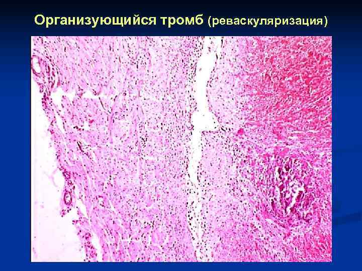 Тромб микропрепарат. Обтурирующий тромб патанатомия микропрепарат. Тромбоэмболия патанатомия. Организованный Троиб в артерии патанат.