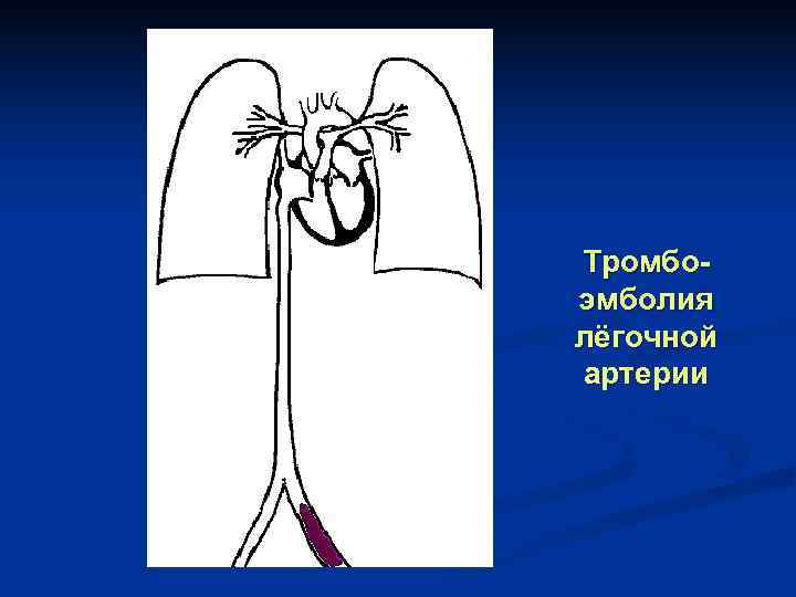 Тромбо- эмболия лёгочной артерии 