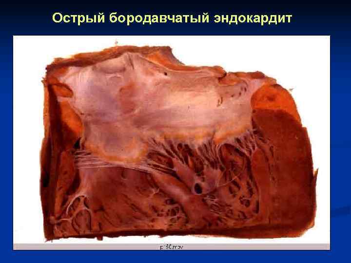 Острый бородавчатый эндокардит 