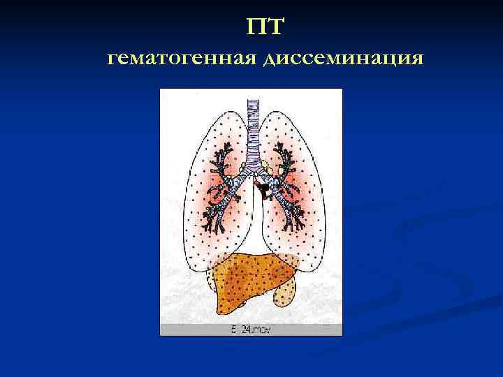   ПТ гематогенная диссеминация 