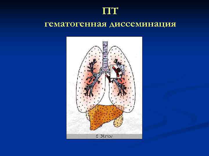   ПТ гематогенная диссеминация 