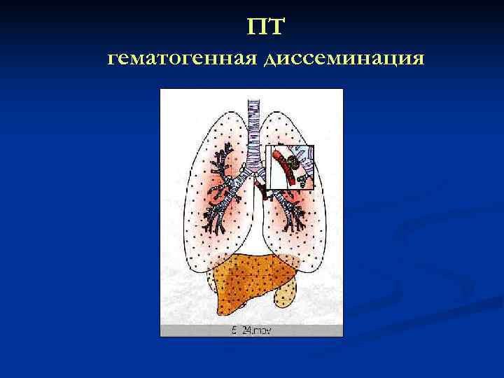   ПТ гематогенная диссеминация 