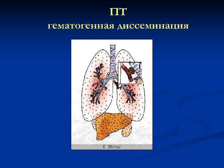   ПТ гематогенная диссеминация 