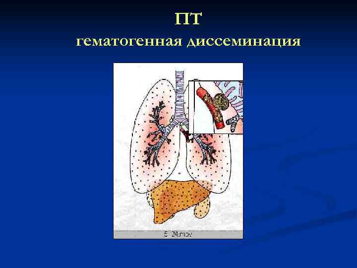   ПТ гематогенная диссеминация 