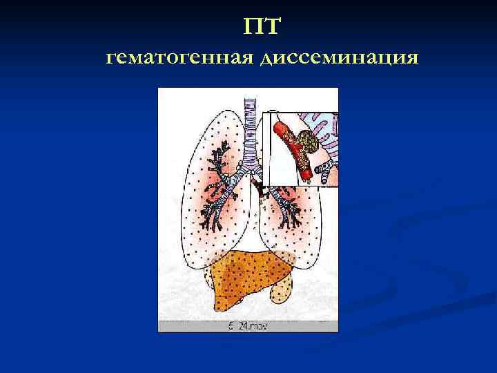   ПТ гематогенная диссеминация 