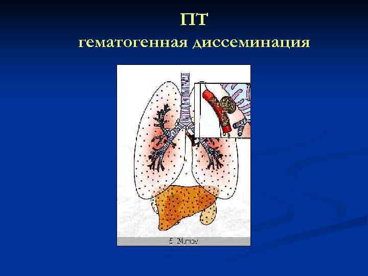   ПТ гематогенная диссеминация 