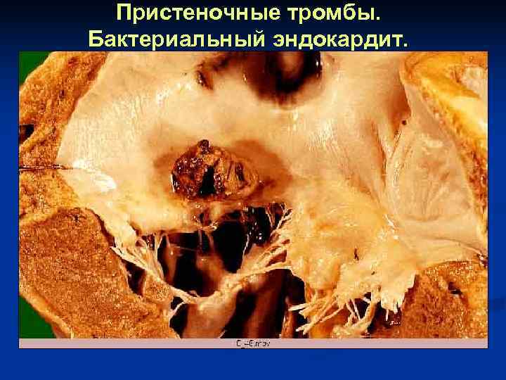  Пристеночные тромбы. Бактериальный эндокардит. 
