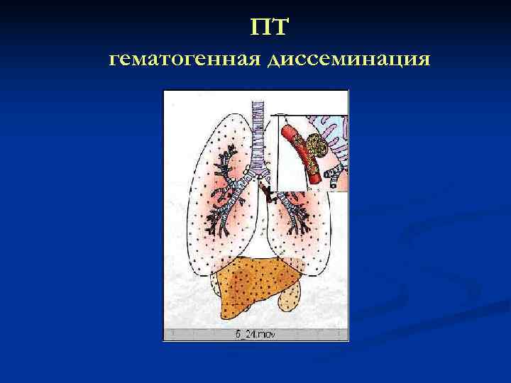   ПТ гематогенная диссеминация 