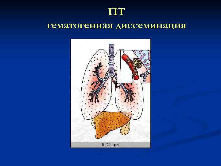   ПТ гематогенная диссеминация 