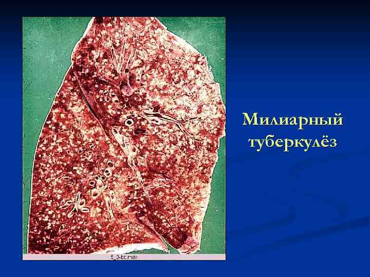 Милиарный туберкулёз 