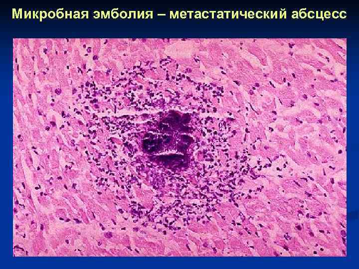 Микробная эмболия – метастатический абсцесс 