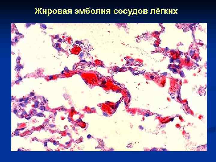 Жировая эмболия сосудов лёгких 