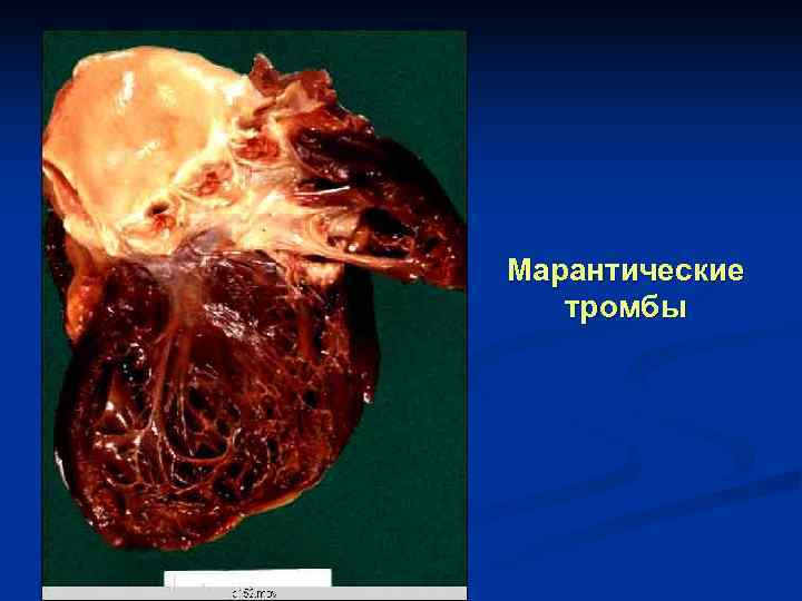 Марантические  тромбы 