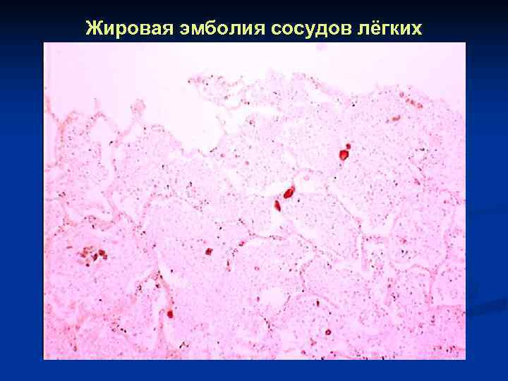 Жировая эмболия сосудов лёгких 