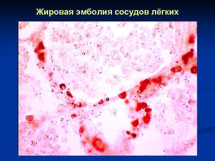 Жировая эмболия сосудов лёгких 