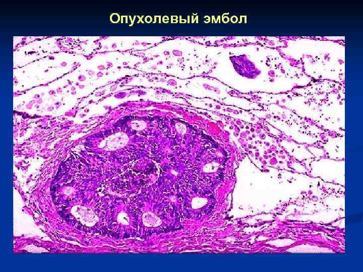 Опухолевый эмбол 