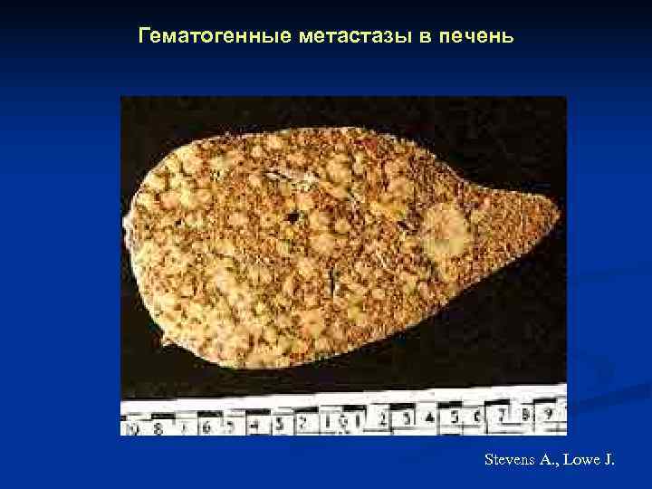 Гематогенные метастазы в печень       Stevens A. , Lowe
