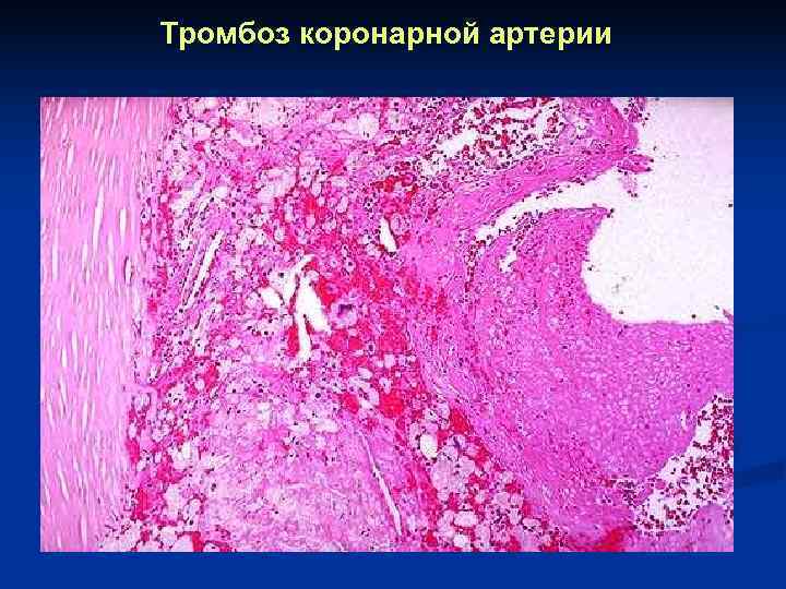 Тромбоз коронарной артерии 