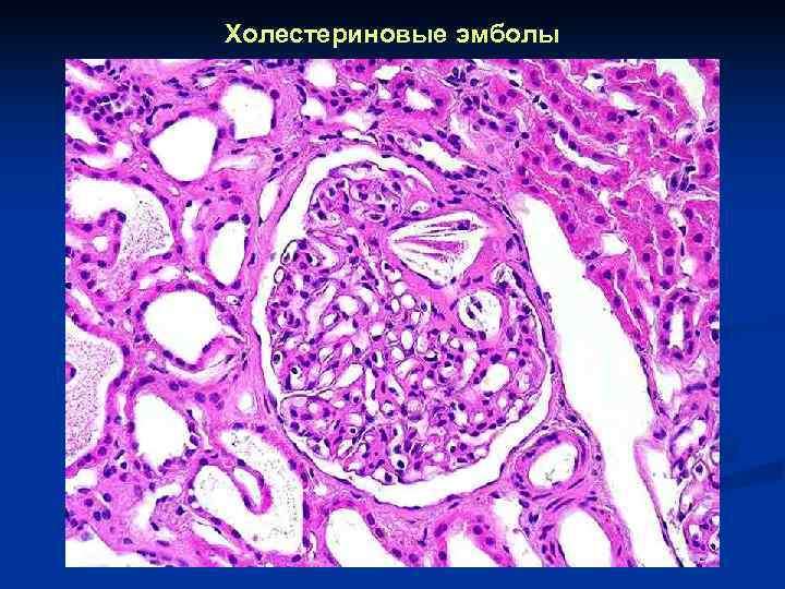 Холестериновые эмболы 