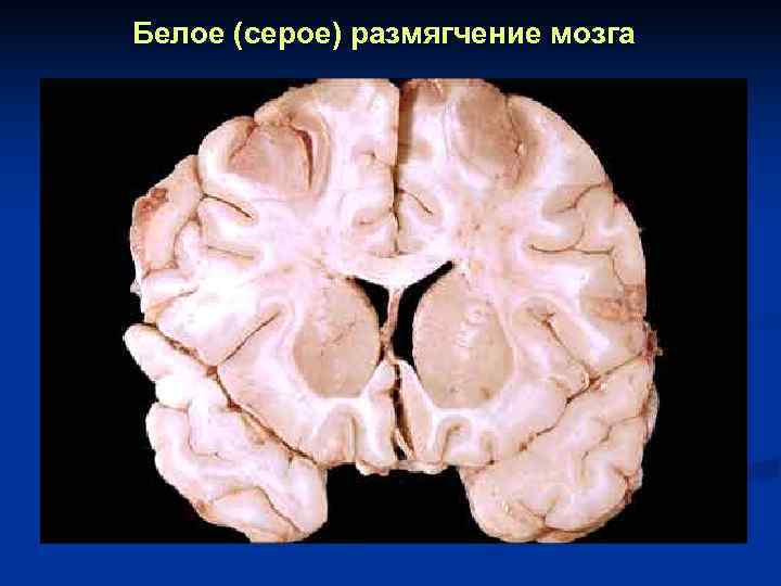 Есть инфаркт мозга. Колликвационный некроз головного мозга. Ишемический инсульт мозг макропрепарат. Ишемический белый инфаркт головного мозга макропрепарат. Очаг серого размягчения головного мозга.