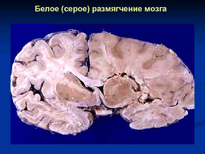 Белое (серое) размягчение мозга 