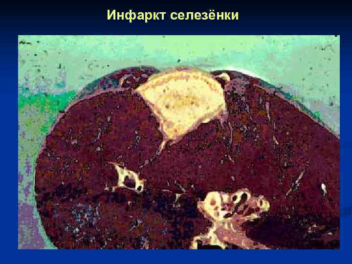 Инфаркт селезёнки 