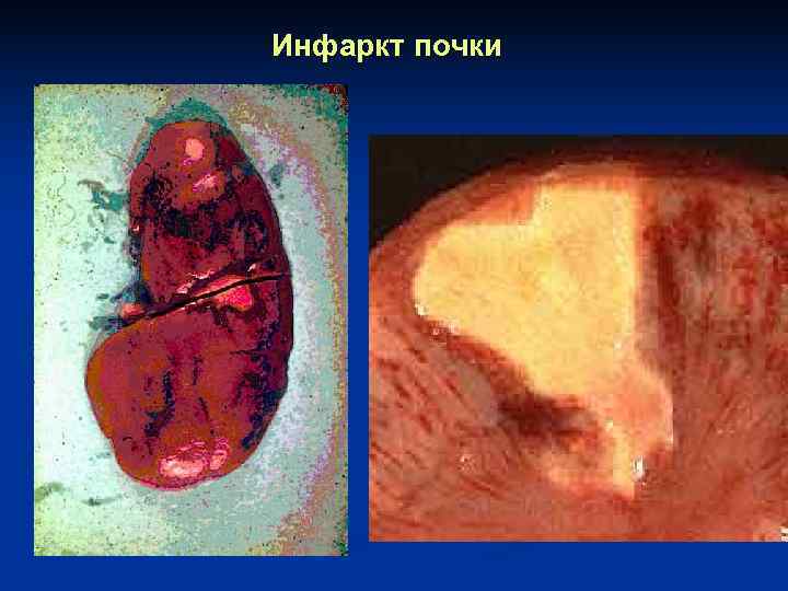 Инфаркт почки 