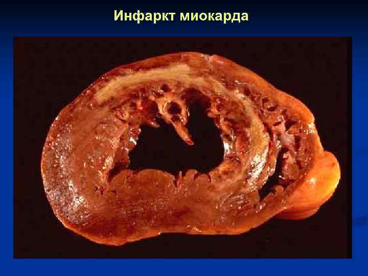 Инфаркт миокарда 