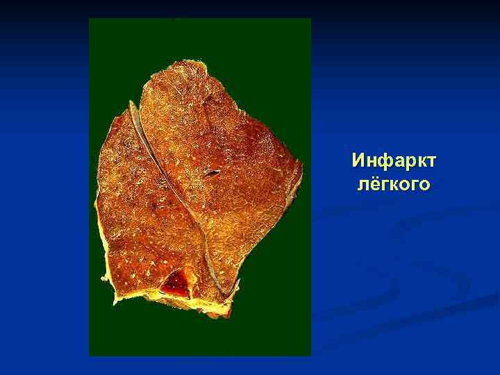 Инфаркт лёгкого 