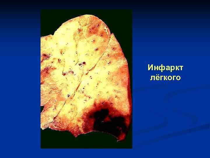 Инфаркт лёгкого 