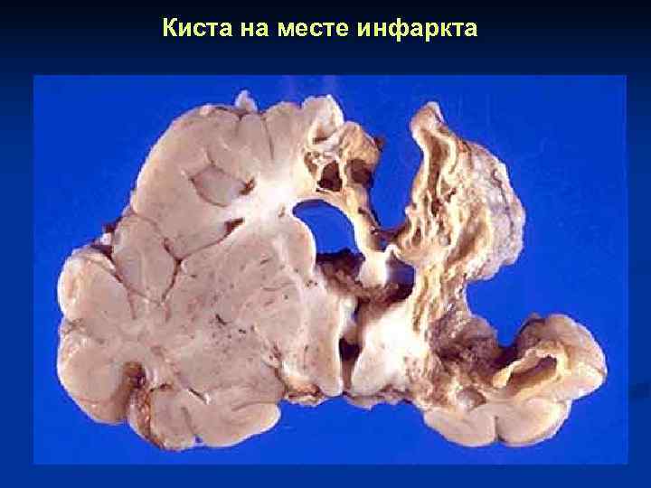 Киста на месте инфаркта 