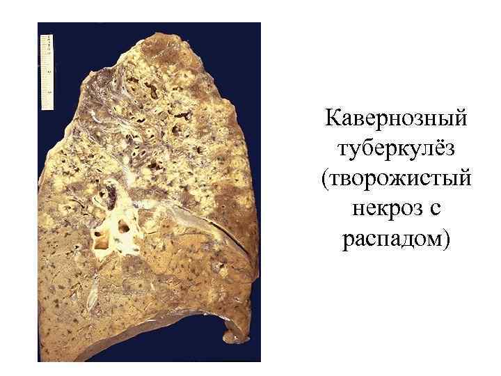  Кавернозный  туберкулёз (творожистый  некроз с  распадом) 