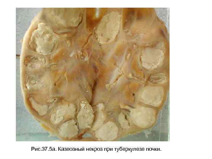 Рис. 37. 5 а. Казеозный некроз при туберкулезе почки. 
