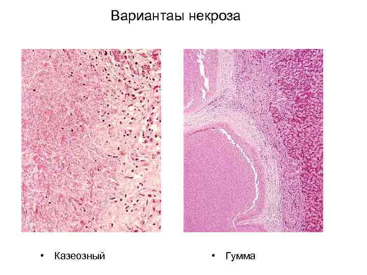    Вариантаы некроза • Казеозный   • Гумма 
