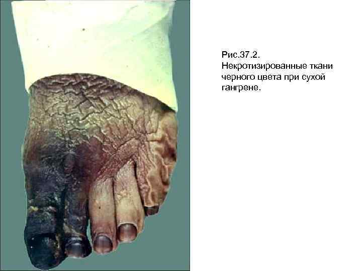 Рис. 37. 2. Некротизированные ткани черного цвета при сухой гангрене. 
