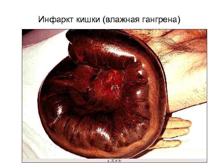 Инфаркт кишки (влажная гангрена) 
