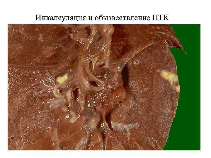 Инкапсуляция и обызвествление ПТК 