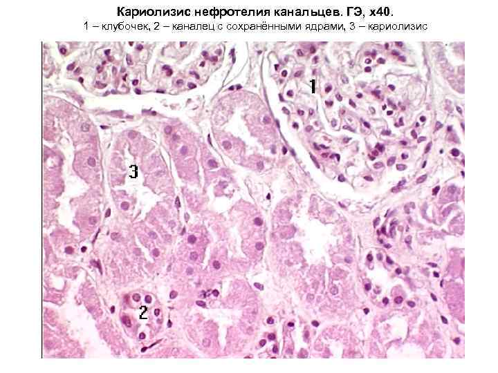  Кариолизис нефротелия канальцев. ГЭ, х40. 1 – клубочек, 2 – каналец с сохранёнными