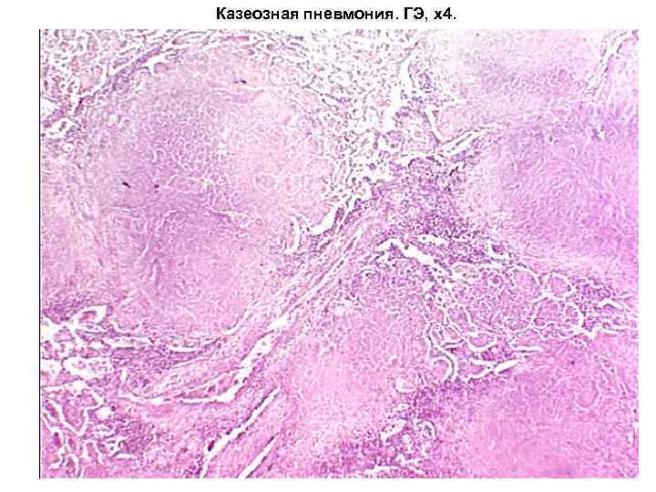 Казеозная пневмония. ГЭ, х4. 