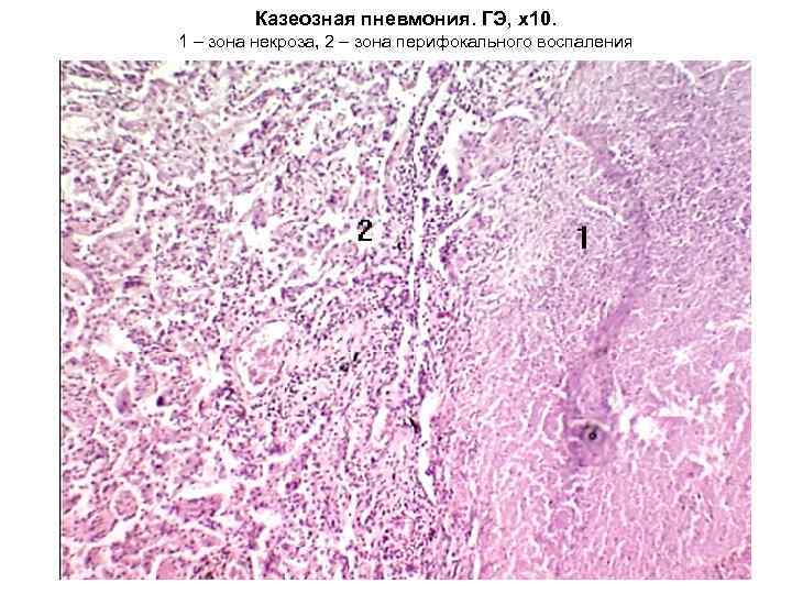   Казеозная пневмония. ГЭ, х10. 1 – зона некроза, 2 – зона перифокального