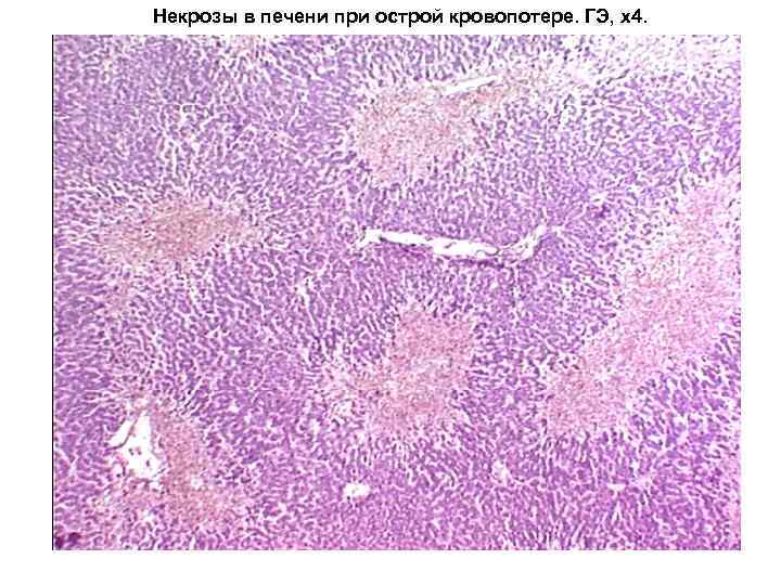 Некрозы в печени при острой кровопотере. ГЭ, х4. 