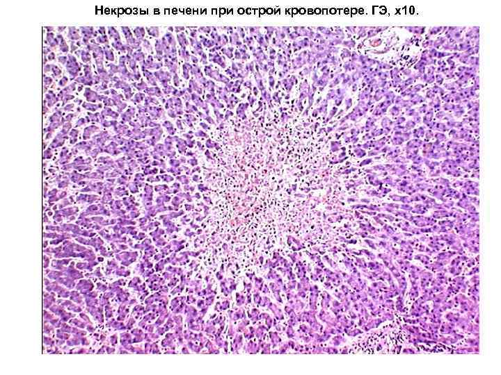 Некрозы в печени при острой кровопотере. ГЭ, х10. 