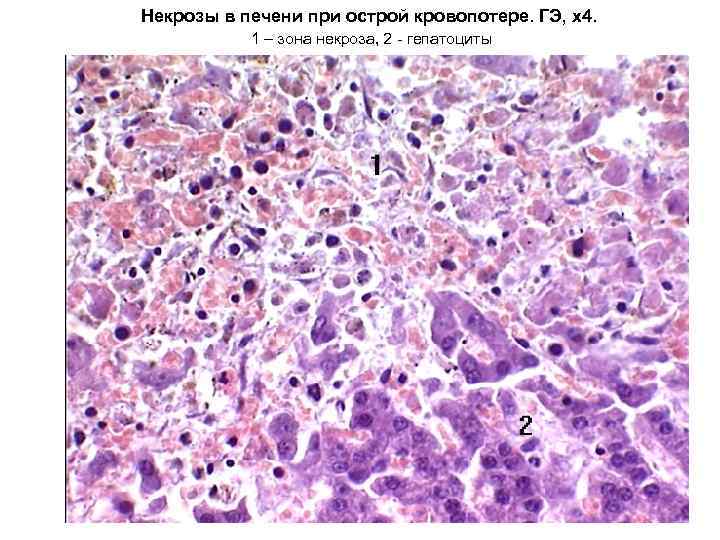 Некрозы в печени при острой кровопотере. ГЭ, х4.   1 – зона некроза,
